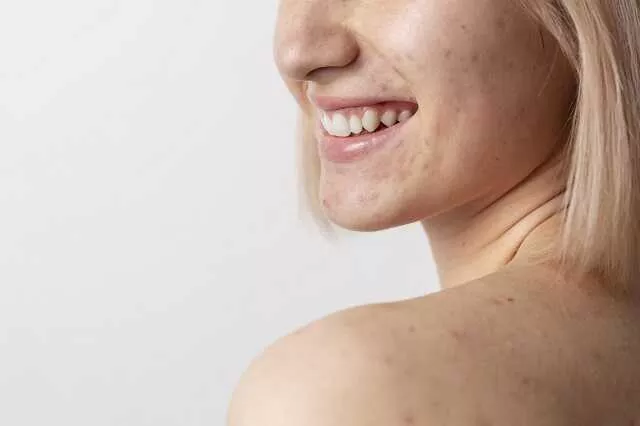 Czym się kierować wybierając krem nawilżający do cery tłustej? Zasady pielęgnacji skóry