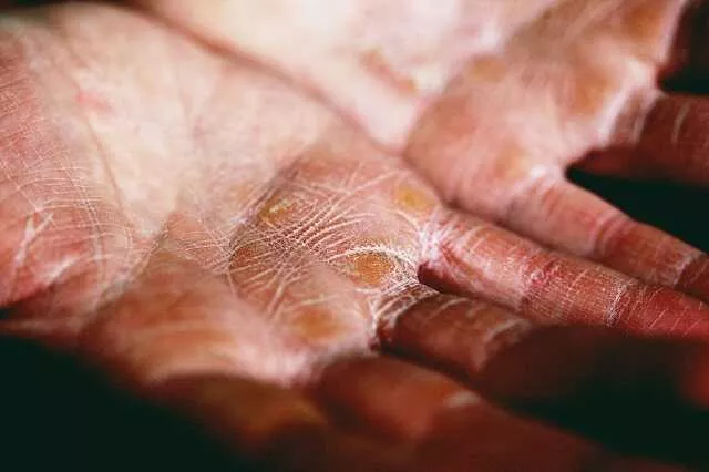 sucha skóra na dłoniach